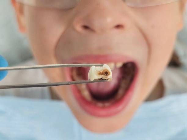 Best Emergency Wisdom Teeth Removal in Man, IL